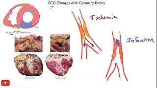 Myocardial ischemia amp infarction  STEMI NSTEMI Q wave infarction Wellens syndrome [upl. by Kravits669]