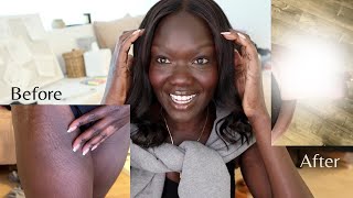 Vlog Stretch Mark Removal on Dark Skin [upl. by Ahsirtak]