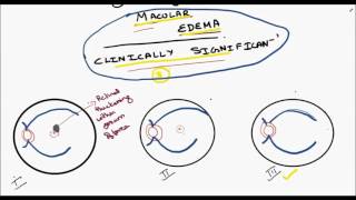 clinically significant macular edema [upl. by Aivilo]