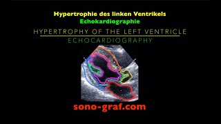 Echokardiographie  Hypertrophie des linken Ventrikels [upl. by Natan]