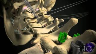 Ghost Productions  DePuy Spine  Cervical [upl. by Rotce]