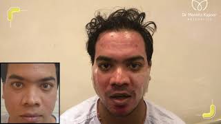 Dermabrasion Skin Treatment  Acne Scar Treatment in Delhi India [upl. by Farlie]