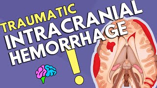 Intracranial Hemorrhage [upl. by Drice]