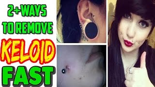 How To Get Rid Of Keloid  2 Ways To Remove Keloids Naturally at home [upl. by Nnairrek481]