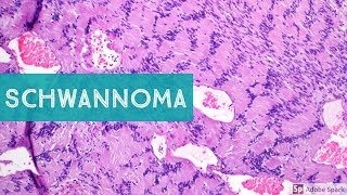 Schwannoma NeurilemmomaExplained by a Soft Tissue Pathologist [upl. by Raffaj442]