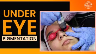 Laser treatment for dark circles under eyes  Under Eye Pigmentation Removal [upl. by Alleinnad]