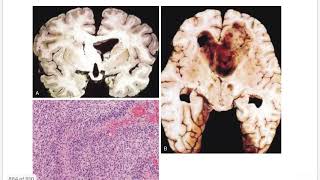 TUMORS Of CNS  Gliomas Astrocytoma  Oligodendroglioma  Midline Glioma  Ependymoma [upl. by Albers]