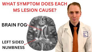 What Symptom Does Each Multiple Sclerosis MRI Lesion Cause Neurologist Explains [upl. by Catrina]