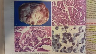 Papillary Thyroid Carcinoma  SPECIAL PATHOLOGY [upl. by Aliekat]