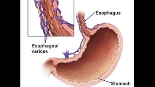 Esophageal Varices [upl. by Siward]