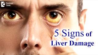 Liver disease Symptoms in adults 5 Signs your liver is damaged  Dr Ravindra B S  Doctors Circle [upl. by Cinamod809]