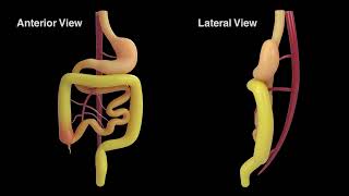 New Revelations in the Pathophysiology and Surgical Management of Congenital Gut Malrotation [upl. by Lose]