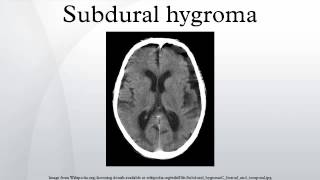 Subdural hygroma [upl. by Ecinerev]