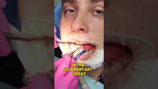 Dental Anesthesia Explained Stay PainFree at the Dentist shorts [upl. by Avictor490]