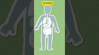 Silicosis  Respiratory Disease  affects the lungs upsc ias [upl. by Ennaesor]