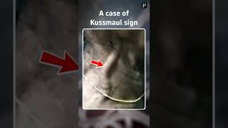 Case of Kussmauls sign [upl. by Broida]