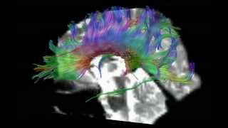 DTI Tractography of Corpus Callosum [upl. by Naol]