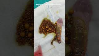 Multiple Gall Bladder stones DrAshishSachan [upl. by Wilkey]