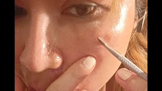 peeling my dark spots skin skincare skincareroutine skincaretips peeling skinpeel retinol [upl. by Nico]