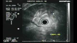 CHRONIC PANCREATITIS ENDOSCOPIC ULTRASOUND CHRISTOS KARALIS MDwmv [upl. by Emerson]