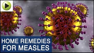 Skin Care  Measles  Natural Ayurvedic Home Remedies [upl. by Camilo253]