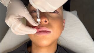 Expert Lip Filler Tutorial Safe Injection Techniques for Perfect Results [upl. by Puett718]