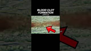 What is a BLOOD CLOT Doctor Explains medical education science [upl. by Einhapets]