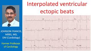 Interpolated ventricular ectopic beats [upl. by Mari]