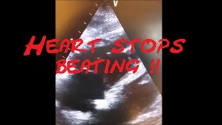 Cardiology Echo QuizCase Heart stops beating Part 1 SCD VT SVT AVRT AVNRT Sinus Tach [upl. by Haidabej]