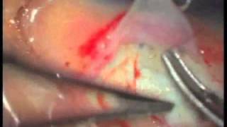 Combined trabeculotomy and trabeculectomy for Pediatric Glaucoma [upl. by Nade]