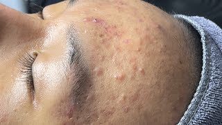 ACNE TREATMENT VU QUYNH MI  Blackheads Perennial EveryWhere Squeeze Forehead [upl. by Dov]