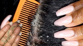 Scalp scratching and picking  Satisfying Dandruff Removal ASMR  Psoriasis [upl. by Kwon]