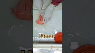 uterus with bilateral adnexa specimen [upl. by Oiram]