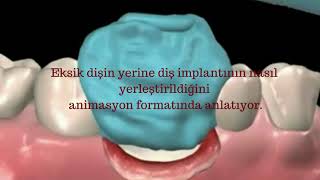 İmplant Diş Takılması  Bu Video Adım Adım Dental İmplant Cerrahisi  Dr Ömer Pirinç 0216 577 60 08 [upl. by Garvy318]