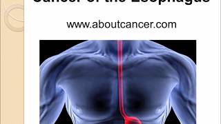 Esophagus Cancer [upl. by Willis]