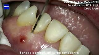 Sondeo Periodontal [upl. by Lichter]