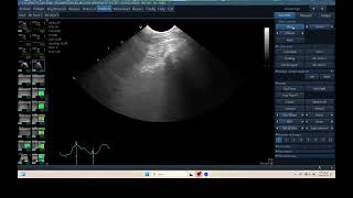 IQ 298 TFAST LUNG B LINE PULMONARY EDEMA HWD ECHOPAC ANALYSIS [upl. by Ecirtac]