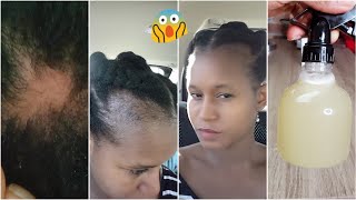 Best Homemade Remedy To Regrow Your Baldspots Edges And Crown Area Naturally Stop Hair Fall [upl. by Nina]