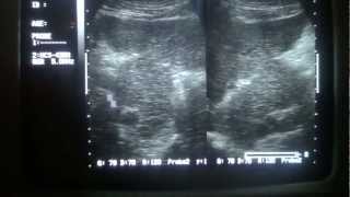 ultrasound hyperplasia of caudate lobe of liver [upl. by Rosenfeld]