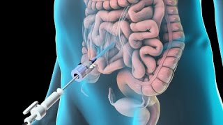 Laparoscopic Lysis of Abdominal Adhesions 2011 [upl. by Cyrill]