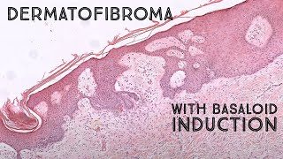 Dermatofibroma with basaloid follicular induction mimic of basal cell carcinoma pathology [upl. by Nnayram398]