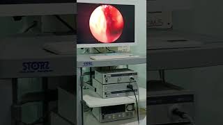 ENDOSCOPIC ETHMOID SINUS EXPLORATION maxillofacialsurgeon face surgeryrecovery youtubeshorts [upl. by Willett]