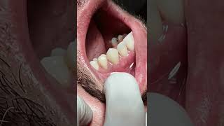 Tooth crowns after RCT satisfying [upl. by Dalpe]