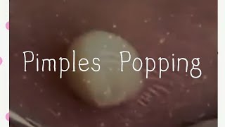 Pimples amp Blackheads Popping  59 [upl. by Herrah876]