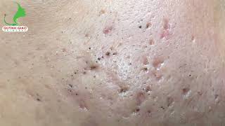 Satisfying SkinCare Blackheads Acne Extraction Video With Dr Thuy QGSPA Date Nov122024 1 [upl. by Einnaej156]