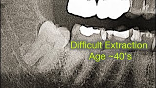 Difficult Extraction in an older Patient Buccal Trough  Sectioning of Wisdom Tooth [upl. by Eliathas171]