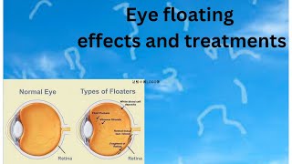 Eye floaters causes and treatments [upl. by Aimal]