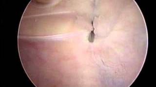 Arthroscopic Lateral Release and VMO Plication  ORV  Stanley Tao MD [upl. by Aneele381]