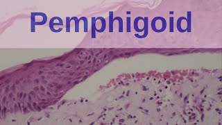 Bullous Pemphigoid  Pathology mini tutorials [upl. by Seravaj]