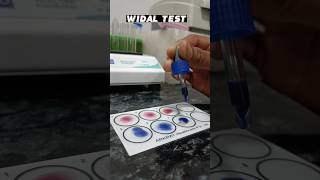 WIDAL test 😱 कैसे करते हैं देखो negative positive typhoid trending viral sorts [upl. by Tteraj]